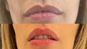 Paciente jóven con labios de buena forma, adelgazados y deshidratados. Se realiza relleno con Ácido  hialurónico y perfilado se logra un labio terso natural y bello